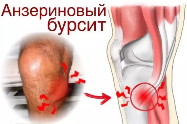 Синдром гусиная лапка коленного сустава