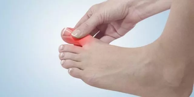Как снять и уменьшить боль при подагре на большом пальце ноги