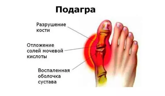 Как снять и уменьшить боль при подагре на большом пальце ноги