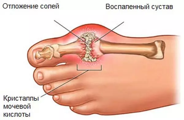 Как снять боль в руке при подагре